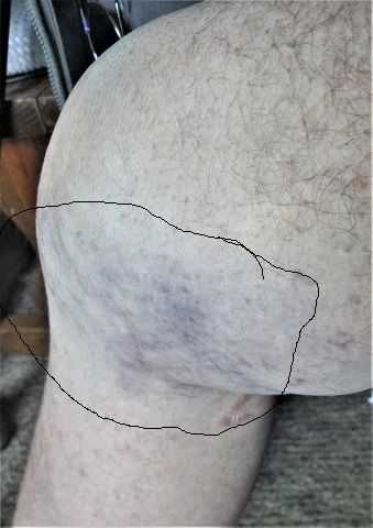 1464143787_Badkneeinside.JPG.56a0c7d29d277589a91ec9f7ab4fbc9c.JPG